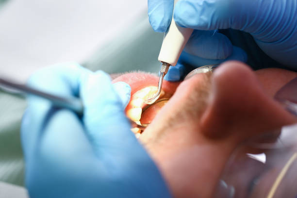 Best Dentist for Tooth Abscess  in Munster, IN